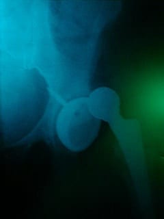 hip_implant